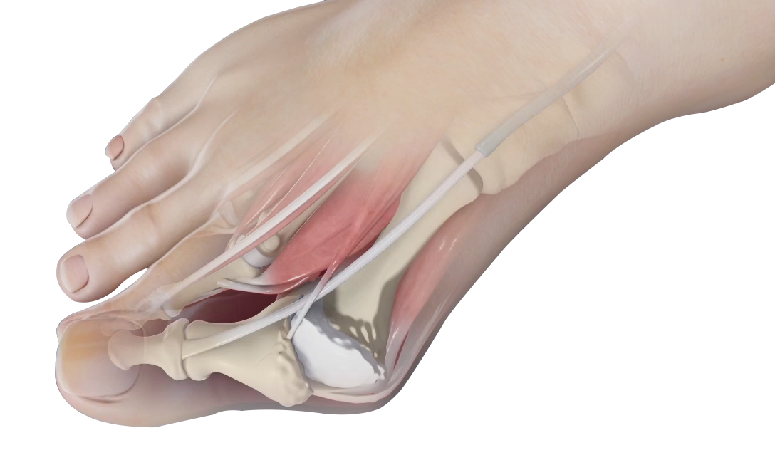 Bunion Correction Memphis Foot Surgeon Memphis Bunion Surgery Memphis