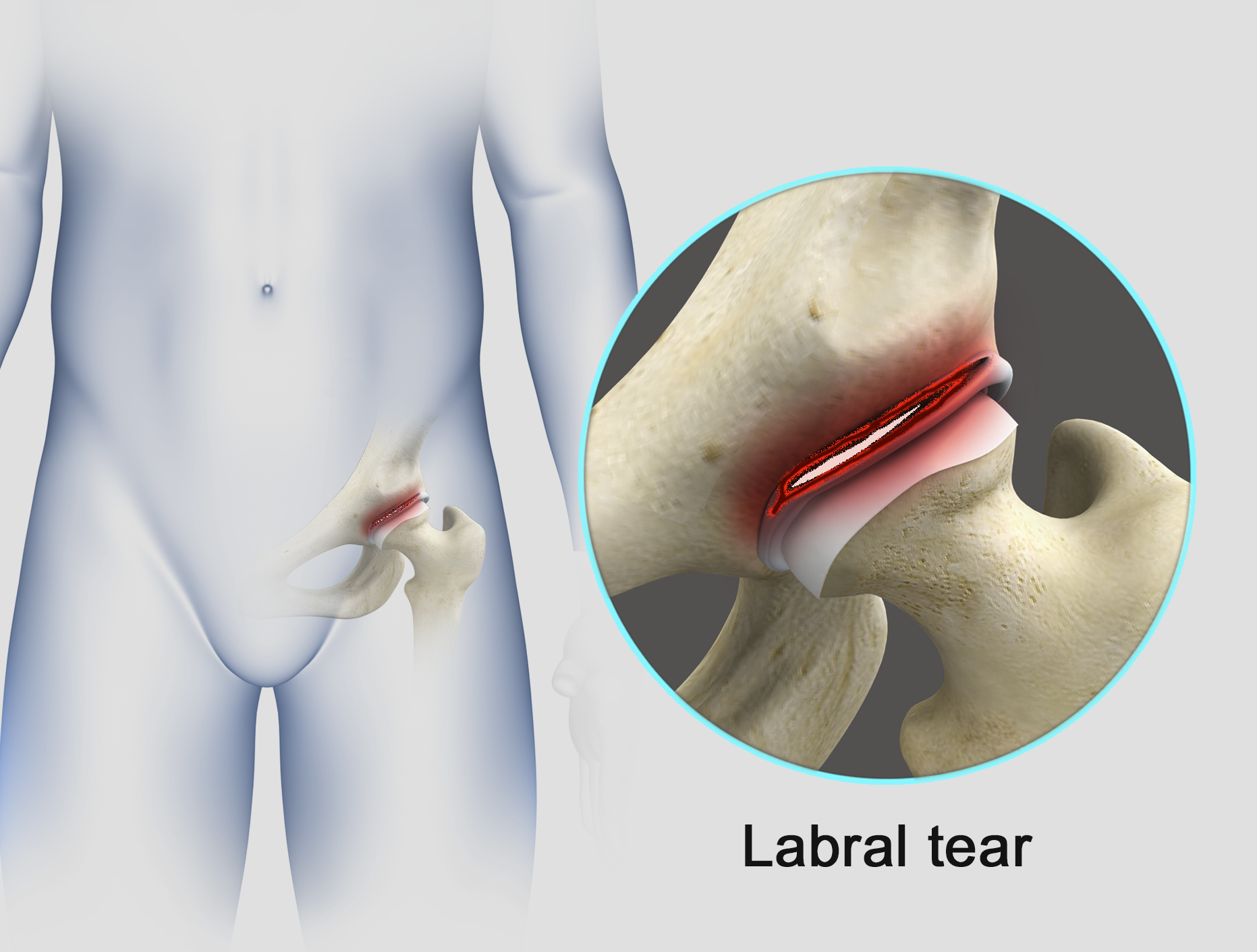 Hip Surgery Memphis Hip Arthroscopy Memphis Hip Replacement Memphis