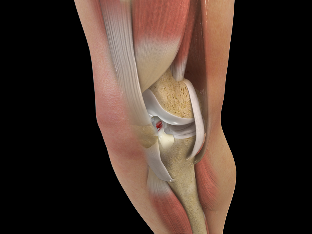https://www.orthonow.com/3d-images/acl_tear.png